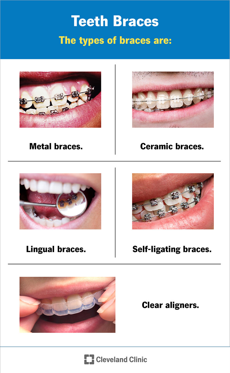 which u brackets are best? compare these top 5 types!