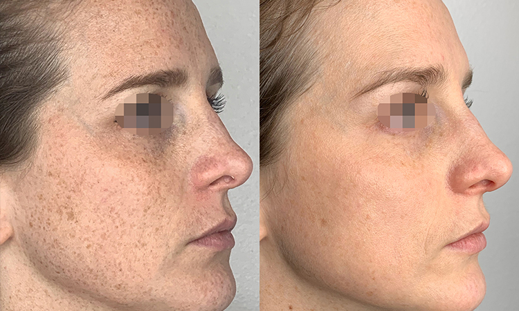 DPL photofacial results and what to expect after