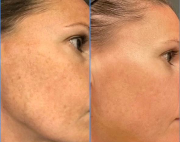 DPL photofacial results and what to expect after