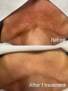 DPL photofacial results and what to expect after