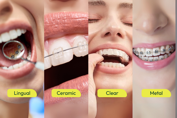which u brackets are best? compare these top 5 types!