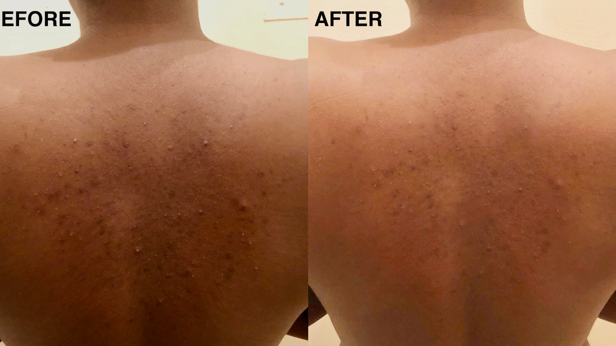 How to deal with b spots? 4 effective methods revealed