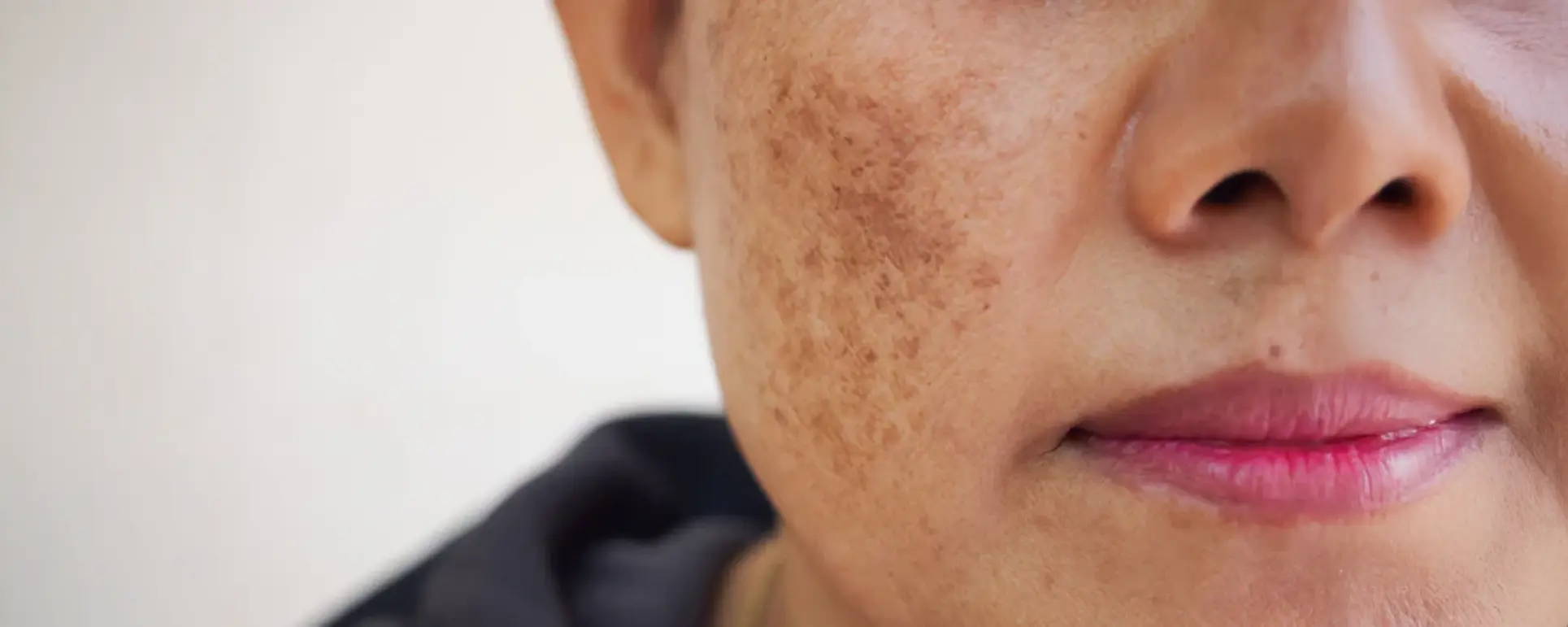 How to deal with b spots? 4 effective methods revealed