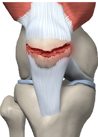 frattura della rotula