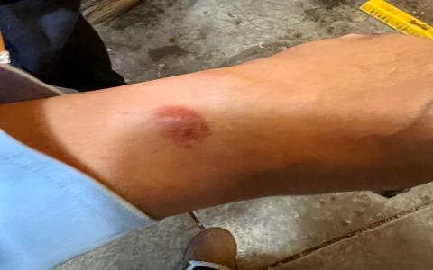 fitbit wrist burn：fitbit wrist irritation
