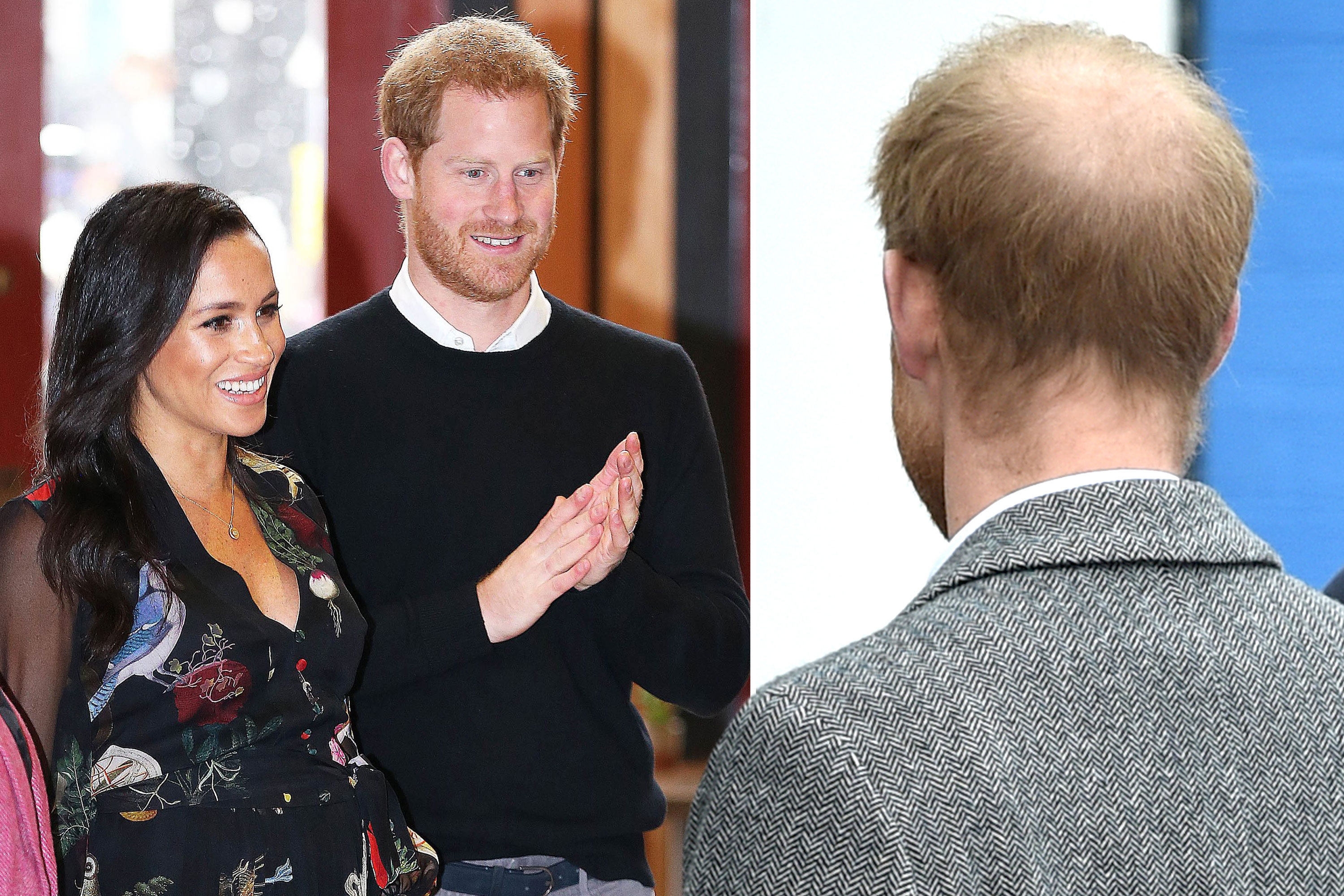 harry baldness:hair loss in harry