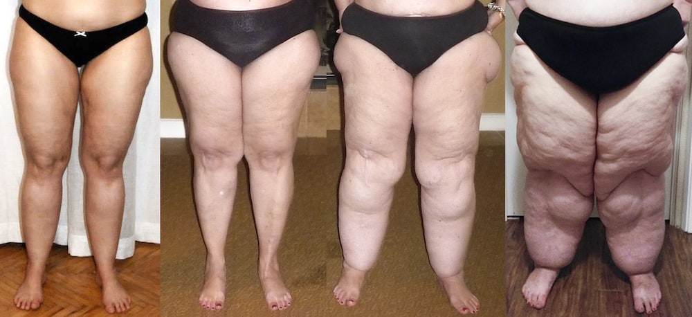 lipoedema nz:lipedema in new zealand