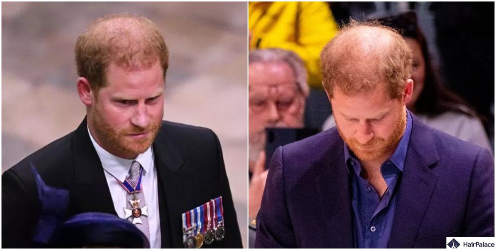 prince hair loss：prince's thinning hair